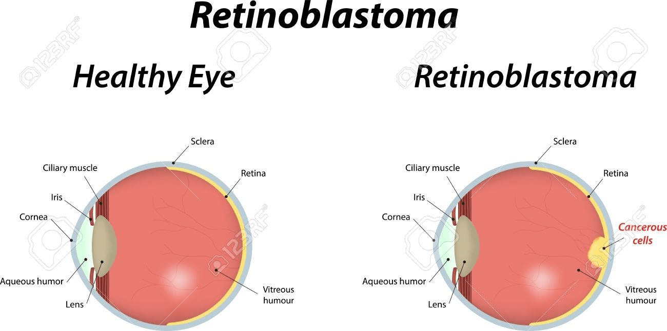 Greater Incidence Of Babies With Retinoblastoma In US-Born Latinas