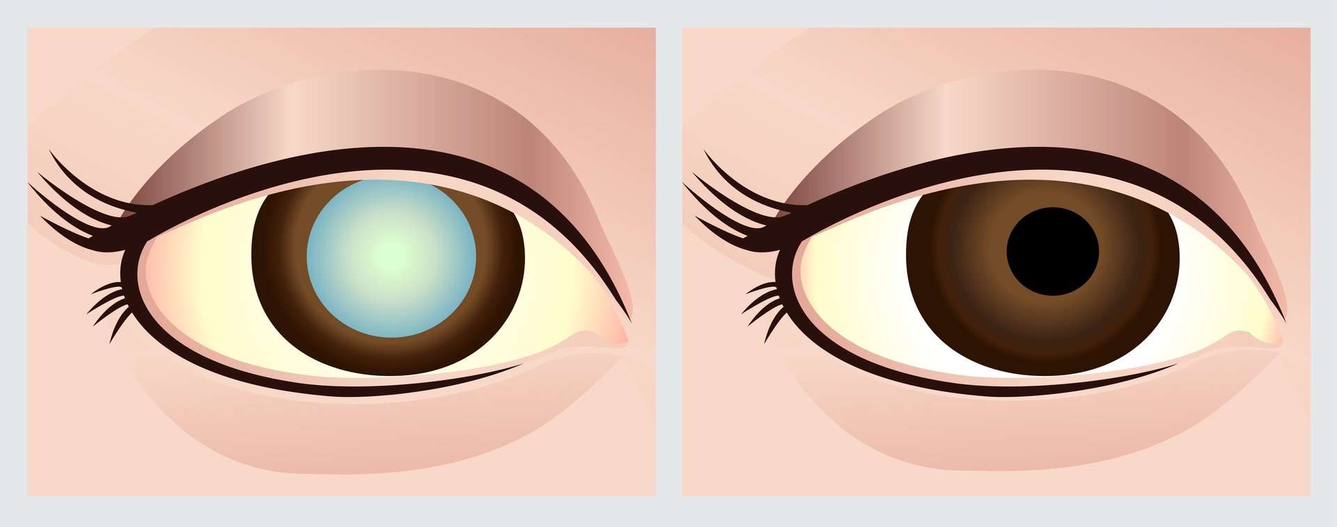 Cataracts Risk Associated WIth Statins